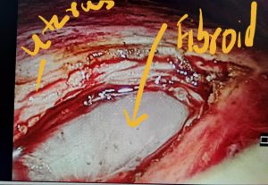 Now fibroid is exposed, the white is the fibroid and red is the uterus ( you can see how the fibroid is inside the uterus).