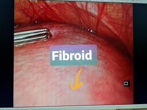 Fibroid is fully inside the uterus and cannot be seen.