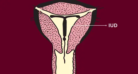 IUD in Vagina