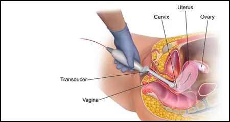 Process of Transvaginal ultrasound